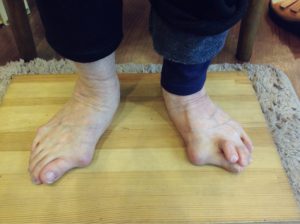 外反母趾、リウマチ