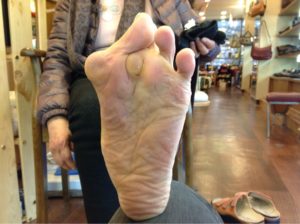 外反母趾、リウマチ